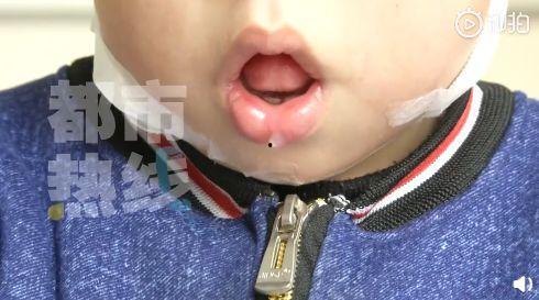 吃蜜瓜上颚破皮刺痛,上颚刺痛背后的甜蜜真相